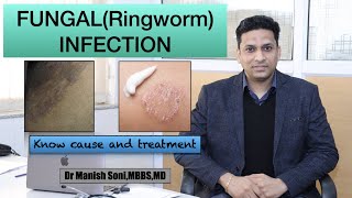 Fungal  Tinea  Ringworm infection [upl. by Woehick]