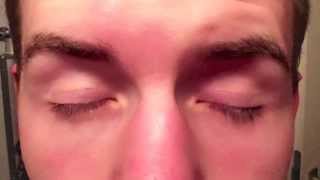 Schlupflid Weg dank Eyelid Tape  Glue Vorher  Nachher  Before  After Video [upl. by Enneira]