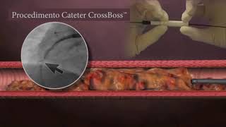 Cateter CrossBoss™ da Boston Scientific  MedCia Brasil [upl. by Ariec244]