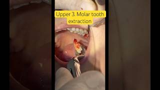 Upper 3 Molar tooth extraction [upl. by Ahsital]