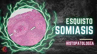 Esquistosomiasis  HISTOPATOLOGÍA [upl. by Adnalohs]