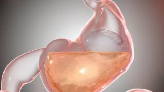 Obalon Gastric Balloon at TLC Surgery [upl. by Scarito411]