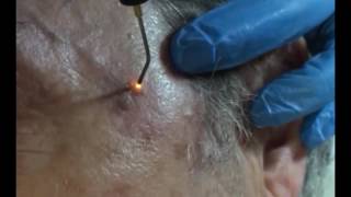 Plasmage  Treatment Fibroma Lentigo [upl. by Inalaeham]