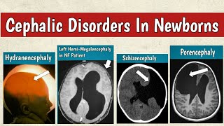 Cephalic Disorders In Newborns  Congenital Brain Malformations Radiology [upl. by Procto26]