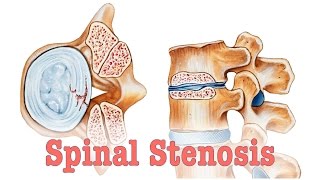 Spinal Stenosis  Surgery vs Chiropractic Care [upl. by Golub]