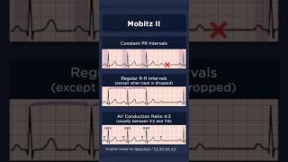 Type II Second Degree Atrioventricular Block ECG AV conduction ratio [upl. by Colin426]