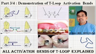 T Loop Explained  Part 34 Demonstration of GableActivationAntiRotation Bends of TLoop Dr Ram [upl. by Quintina]