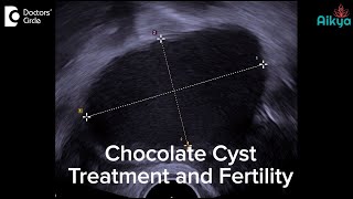 Chocolate Cyst Treatment and Fertility  Dr Sunil Eshwar [upl. by Taddeo]