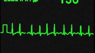 Atrial Fibrillation  AFIB  ECG Simulator  Arrhythmia Simulator [upl. by Ecydnac]