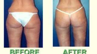 Dr Larry Weinstein reviews LIPOSUCTION [upl. by Enitsirc]