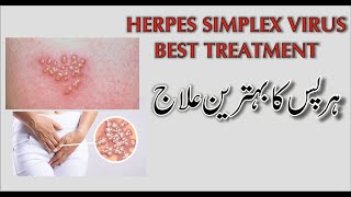 Herpes Simplex Virus  Genital Herpes Treatment in Homeopathy UrduHindi by dr Safdar Iqbal [upl. by Olia473]