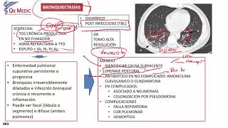 Bronquiectasias [upl. by Nibas]