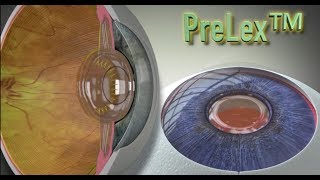 What is PreLex™ [upl. by Ecyrb]