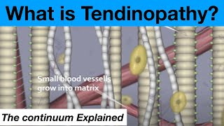 The Tendinopathy Tendon Tendonitis Continuum Theory Explained [upl. by Aicilev580]