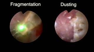 fURS Dusting vs Fragmentation Holmium laser lithotripsy [upl. by Giah]