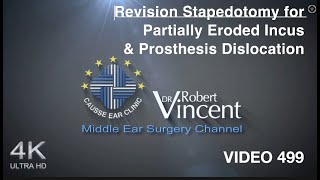 Revision Stapedotomy for Partially Eroded Incus amp Prosthesis Dislocation [upl. by Meluhs184]