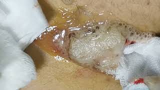 Pilonidal cyst abcess  Kıl dönmesi apsesi [upl. by Jt414]