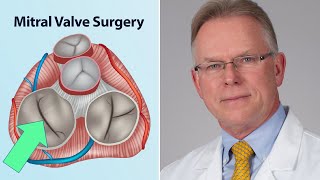 Mitral Valve Surgery What Should Patients Know Interview with Dr Vaughn Starnes [upl. by Charpentier]