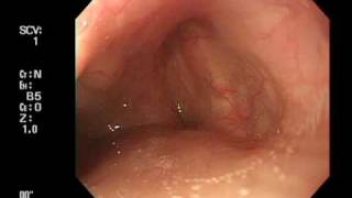 Endoscoe insertion from right pyriform sinus [upl. by Jamill288]