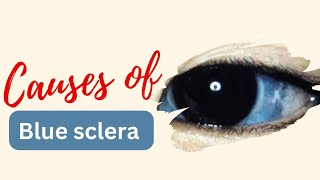 Blue Sclera Causes and Mnemonics Explained [upl. by Yarod]