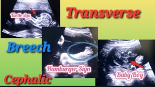 Transverse Breech amp Cephalic Baby In Uterus Genderreveal  Anterior Posterior Placenta Baby Gender [upl. by Gonsalve716]