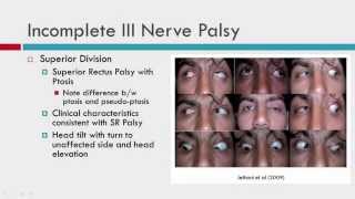 IIIrd CN Palsy Clinical Characteristics [upl. by Kipton]