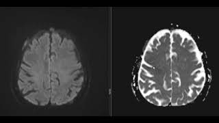 CASE 9 A KNOWN CASE OF bronchogenic carcinoma [upl. by Camm606]