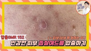 압출SMR 152 얇고 민감한 여드름 피부 압출하기  피부상태 평가하는 법  20대 女 [upl. by Ihsir]