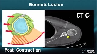 Shoulder InstabilityMRI Part VII Bennett Lesion POLPSA Capsulolabral Rents [upl. by Danica]