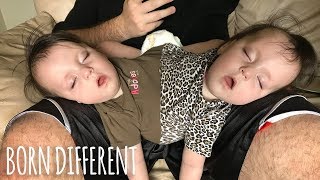 Conjoined Twins Are A Medical Miracle  BORN DIFFERENT [upl. by Sholem]