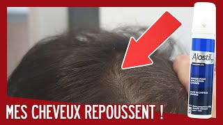 REPRISE DU MINOXIDIL  MES CHEVEUX REPOUSSENT   CALVITIE [upl. by Bainbridge]