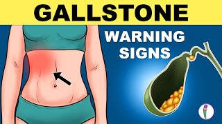 Gallbladder Stones Symptoms  Cholelithiasis  Gallstones Symptoms  Gallstones Warning Signs [upl. by Luedtke]