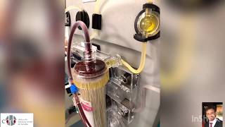 PLASMA EXCHANGE THERAPY PLASMAPHERESIS TUTORIAL [upl. by Worsham]