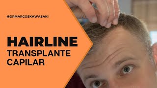 O que é a hairline no transplante capilar [upl. by Wright]