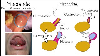 Oral Mucocele  The Most Common Mucosal lesion  Mucous Cyst Symptoms Causes amp Treatment [upl. by Thorlie]