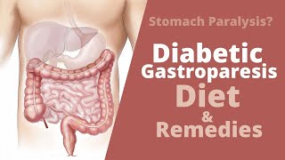 Diabetic Gastroparesis  Diet Modifications Causes and Treatment [upl. by Jowett]