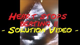 Cardiology Echo QuizCase Heart stops beating Part 2 Solution video [upl. by Jurdi]