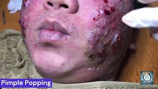 Pimple Popping Blackheads Removal [upl. by Akena131]