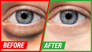 How to Get Rid of Puffy Eyes and Dark Circles [upl. by Enimrac]