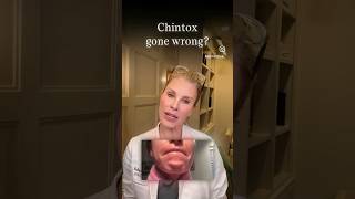 Chin Botox gone wrong botox filler beauty [upl. by Mosnar12]