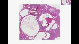 Histopathology KidneyAdult polycystic disease [upl. by Nya597]