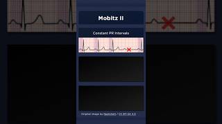 Type II Second Degree Atrioventricular Block ECG Constant PR intervals [upl. by Perry]