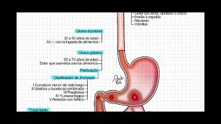 Úlcera péptida gástrica y duodenal [upl. by Talbott4]