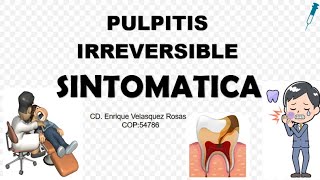 Pulpitis Irreversible Sintomática aguda o subaguda [upl. by Beryl559]