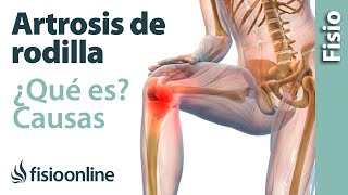 Artrosis o desgaste de rodilla  Qué es causas síntomas y tratamiento [upl. by Mide519]