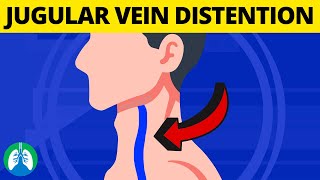 What is Jugular Venous Distention Medical Definition and Explanation [upl. by Braynard165]