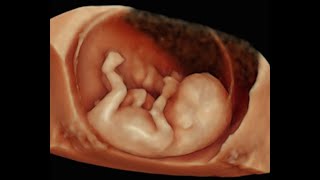 How to Perform 3D Scan of the Baby at 12 Weeks of Pregnancy [upl. by Sivlek]