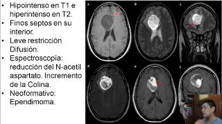 06032021 INTERPRETACION RESONANCIA MAGNETICA  CASO TUMOR CEREBRAL [upl. by Benni215]