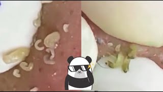 Ultimate Satisfying Pimple Popping Compilation 2024  Best Blackhead amp Acne Removal Video [upl. by Chessa]