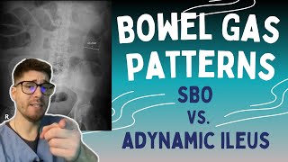 SBO vs Adynamic Ileus Learn the 369 rule to read bowel gas patterns on Xrays [upl. by Curnin]